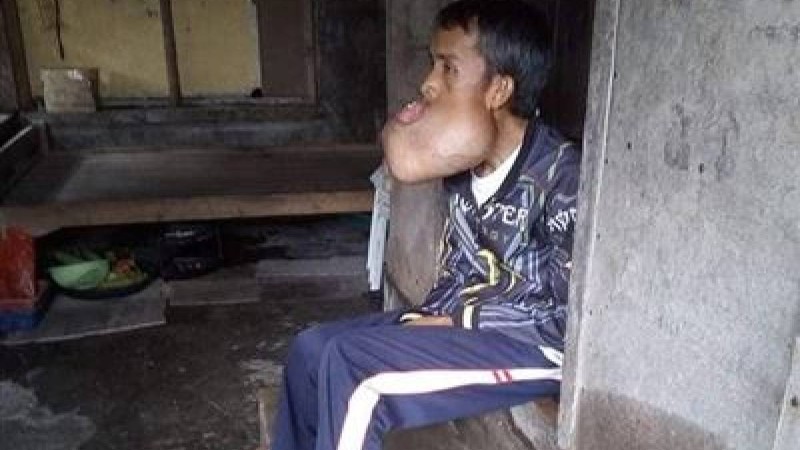 ФОТО: Ер адамның аузына басынан үлкен ісік өскен