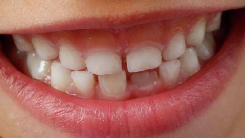 Дәрігерлер баланың 526 тісін жұлып тастады – видео