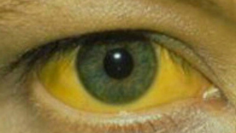 Сарыаурудан сауықтыру халық емі