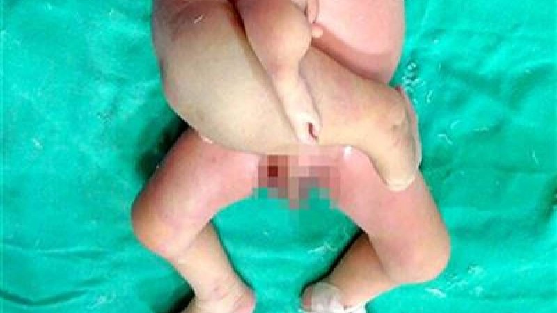 Ұзаққа созылған ота: нәрестенің беріш-егізі кесіп алынды