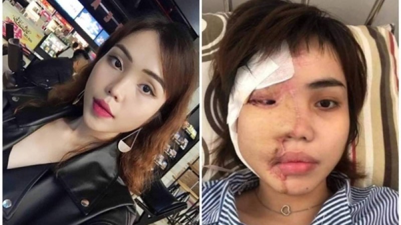 Қызғаншақ жігіт келіншегінің бетіне қышқыл құйып жіберген