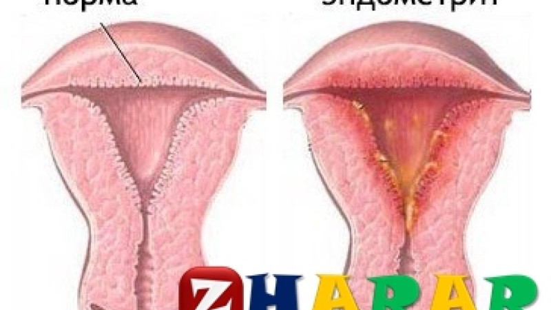 Эндометрит