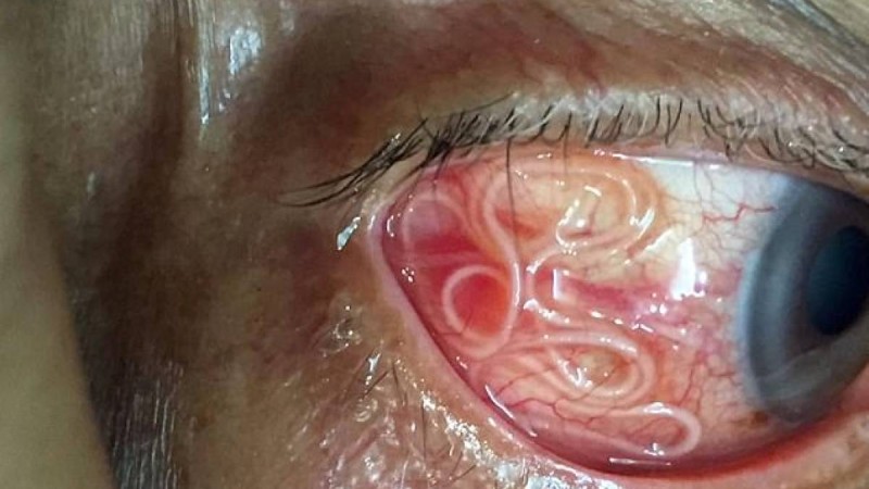 Дәрігерлер сәбидің көзінен 11 құрт алып шықты – жұрттың зәресін алған фото