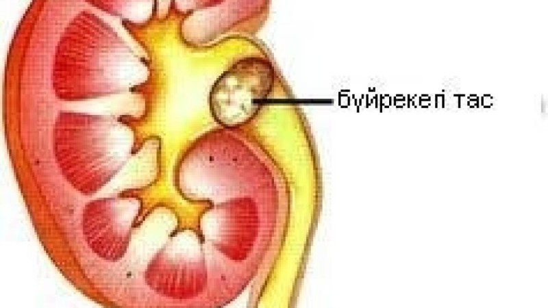 Бүйре қуық жолдарындағы тастан құтылу