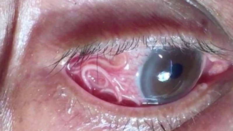 Ер адамның көзінен 15 сантиметрлік құрт шықты (ВИДЕО)