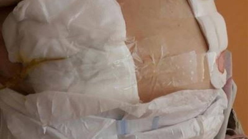 Ота жасатқан науқастың жарасын скотчпен таңып берген