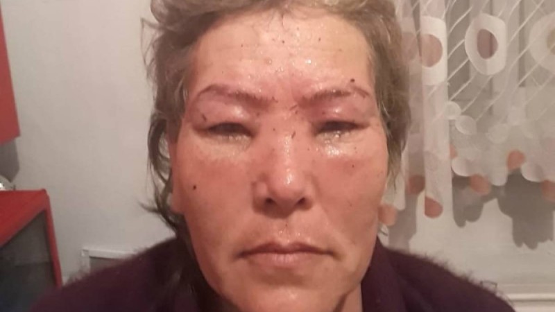 Түркістан облысында сұлулық салонында қасына татуаж жасатқан әйел өліп қала жаздады. - Қазақстан жаңалықтары