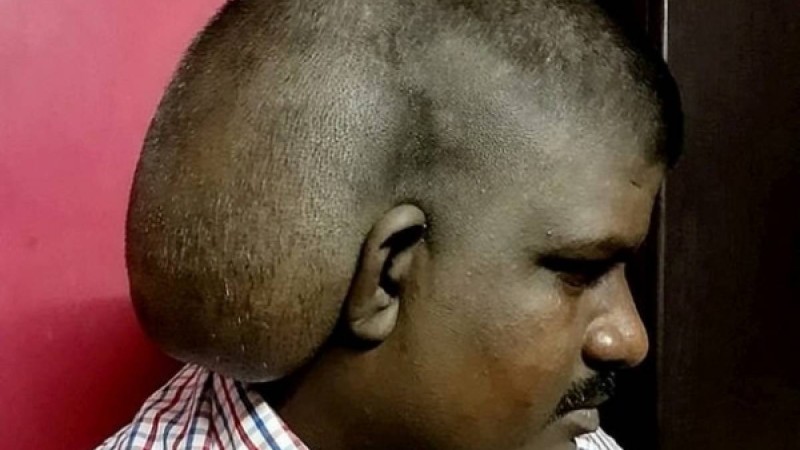 Адамның басына 5 келі ісік өсіп шыққан