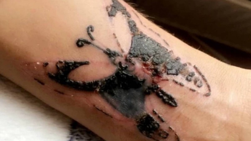 ​Тату салдырған бойжеткен аса қауіпті инфекция жұқтырған