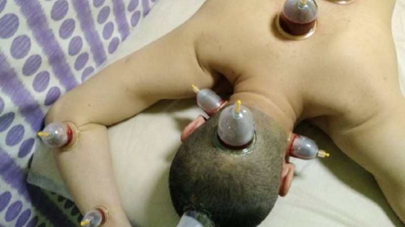 қан алдырудың пайдасы, бастан қан алдыру, оразада қан алдыруға бола ма