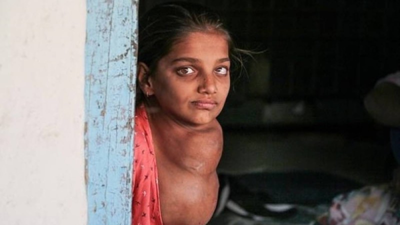 Бүлдіршіннің мойынына басындай көлемді ісік өскен