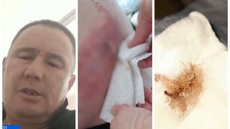 Қарағанды облысы тұрғыны отадан кейін ішінде қалып қойған дәкемен бір жыл жүрген