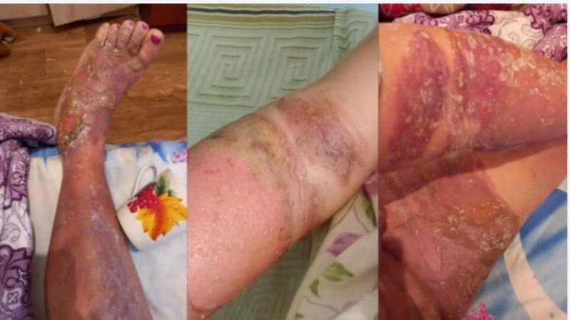 "Жедел жәрдем шақыруға рұқсат бермеген". Ақтөбеде ер адам әйелінің үстіне қайнаған су құйып жіберген