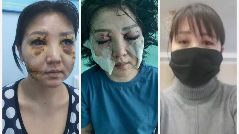 Бұрынғы күйеуі бетін пышақпен тіліп тастаған: Ақтөбелік әйел халықтан көмек сұрады - Қазақстан жаңалықтары