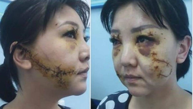 Ақтөбеде бұрынғы күйеуі әйелінің бетін пышақтап тастаған - Қазақстан жаңалықтары