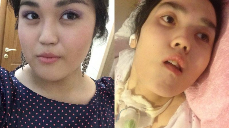 Төсекке таңылған қыздың анасы: Аяғымен барған баланы қолға көтеріп келдік