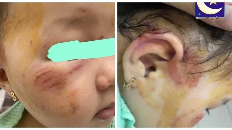 Алматыдағы балабақшаның бірінде бір жарым жастағы қызды ұрып-соққан