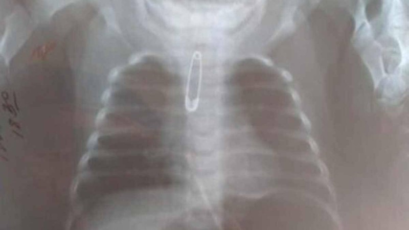 Шымкентте үш айлық баланың ішінен түйреуіш шықты