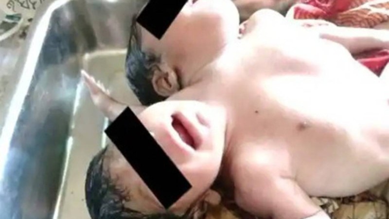 Әйел екі басы мен үш қолы бар қызды дүниеге әкелді