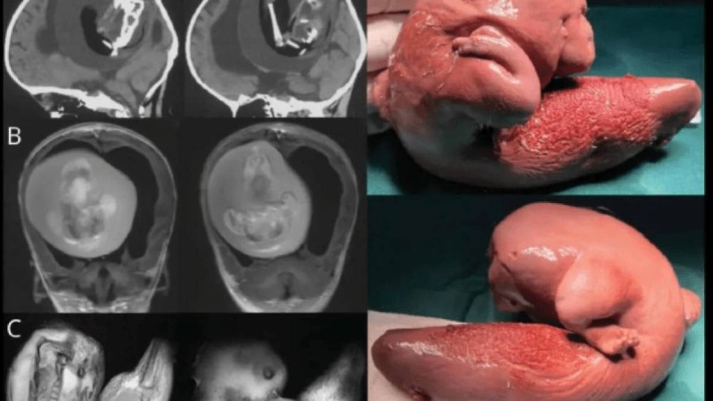 Қытайда бір жасар қыздың миынан егізінің ұрығы анықталды