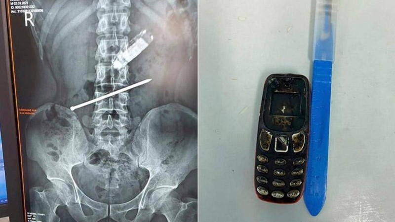 Дәрігерлер телефон жұтып қойған қызылордалық ер адамды құтқарып қалды