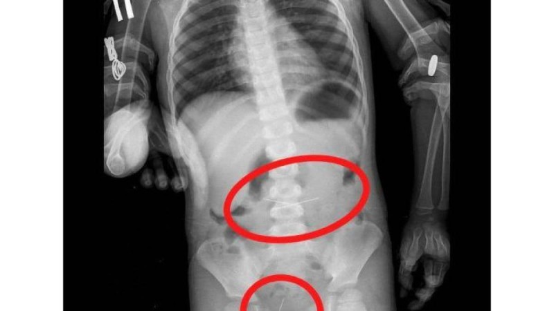 Үш жасар бала төрт тігін инесін жұтып қойған