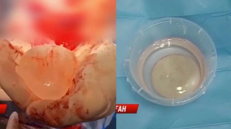 Семейде дәрігерлер бойжеткеннің миынан 7 сантиметрлік құрт алды