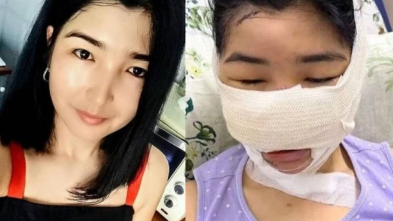 Мұрны мен құлағын кескен: күйеуінен зардап шеккен келіншекке ота жасалды