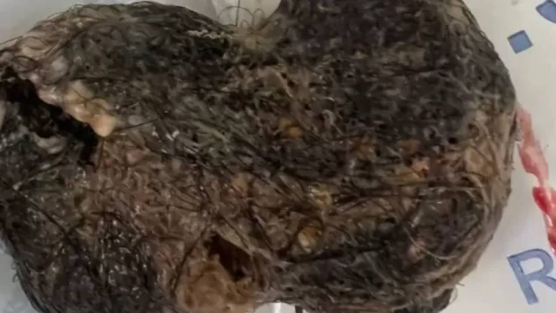Жамбыл облысында бойжеткеннің асқазанынан 30 сантиметрлік тығыз шаш түйіні шықты