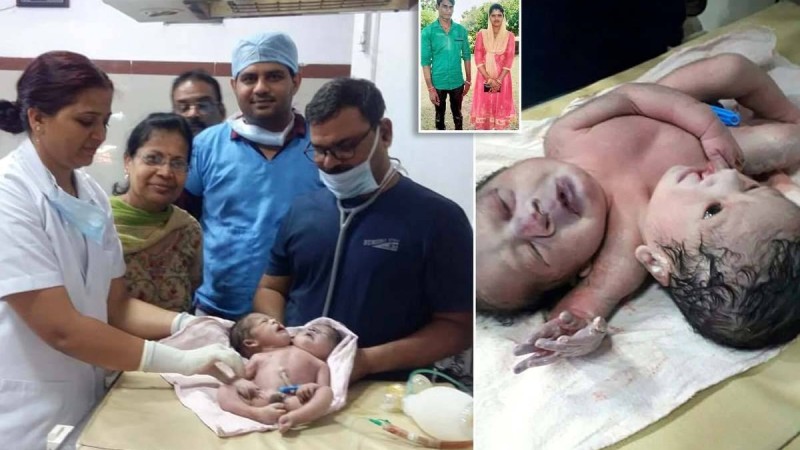 Үндістанда екі басты дені сау бала өмірге келді