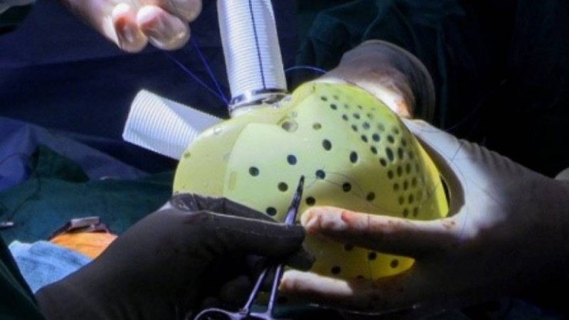 Алматыда ер адамға жасанды жүрек салынды