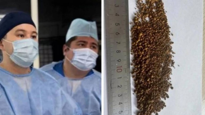 Алматылық дәрігерлер науқастың өт қабынан 5 499 тас алған