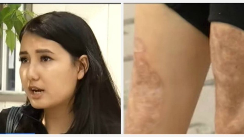 Алматы облысындағы перзентханада ота жасаған әйелдің аяғын күйдіріп жіберген - Қазақстан жаңалықтары