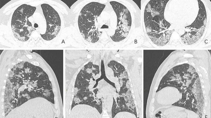 Коронавирус жұқтырғандардың өкпелерінің суреті жұртты шошытты - Қазақстан жаңалықтары