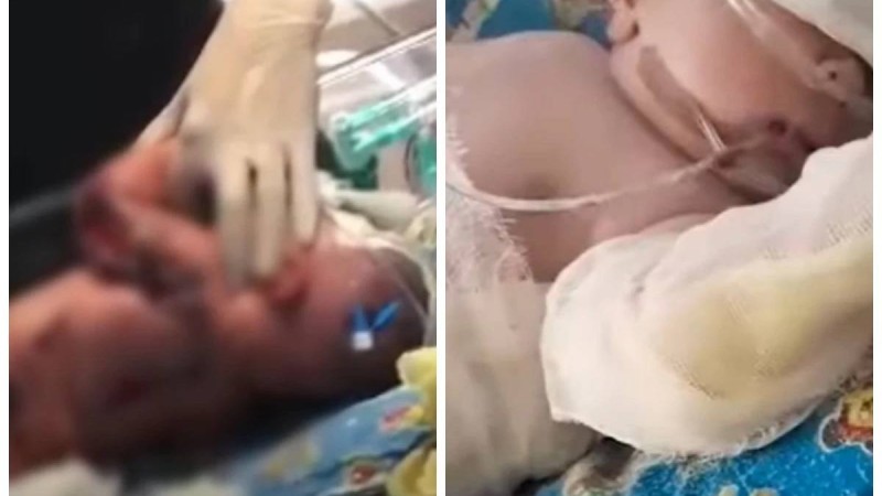 Семейдегі перзентханада дәрігерлер жаңа туған нәрестені күйдіріп алған