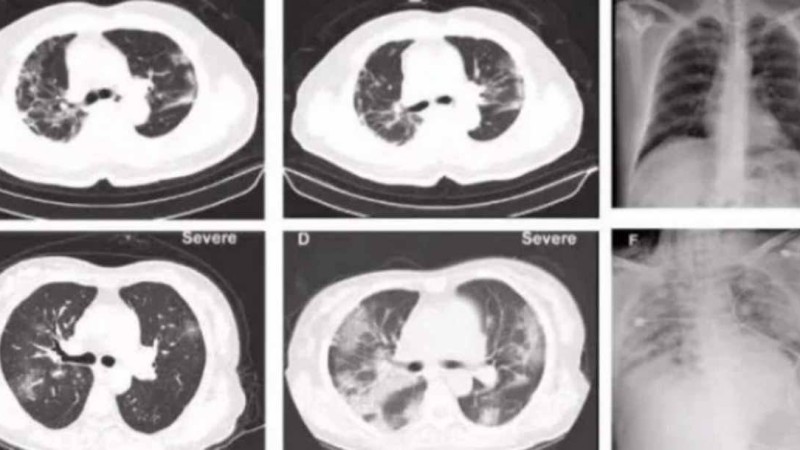 Қытайлық дәрігерлер коронавирустан көз жұмған науқастың денесін сойып, нәтижесін жария етті - Қазақстан жаңалықтары