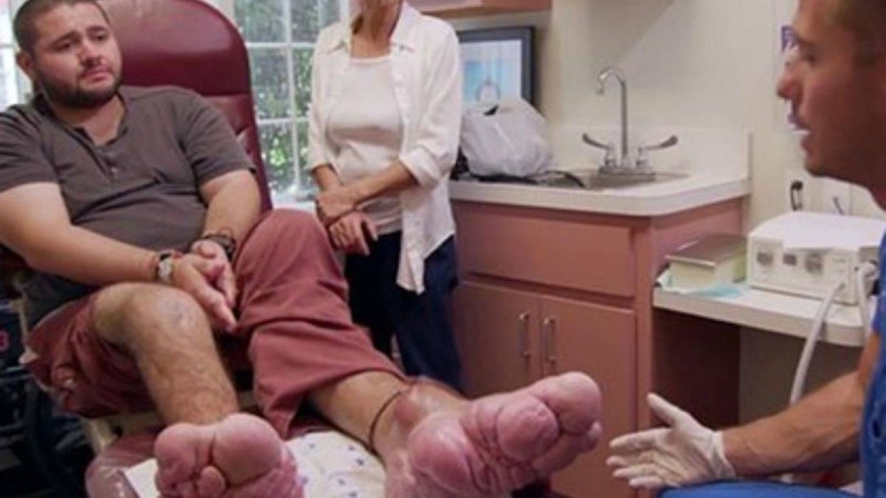 Сирек кездесетін аурудың салдарынан ер адамның аяғы үлкен болып өсіп кеткен - Қазақстан жаңалықтары