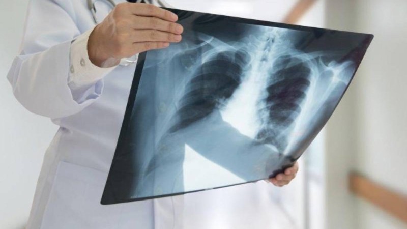 Қазақстанда COVID-19 белгілері бар пневмониямен 158 адам ауырып, 4 науқас көз жұмды