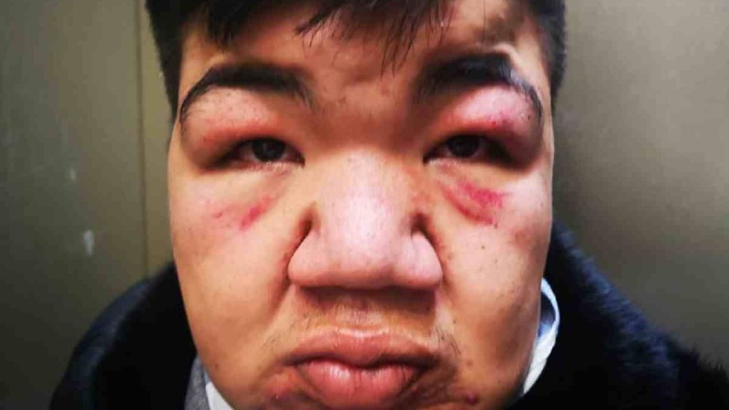 Позитивті және өте мейірімді: Алматыда сирек кездесетін ауруға шалдыққан студентті соққыға жықты - Қазақстан жаңалықтары