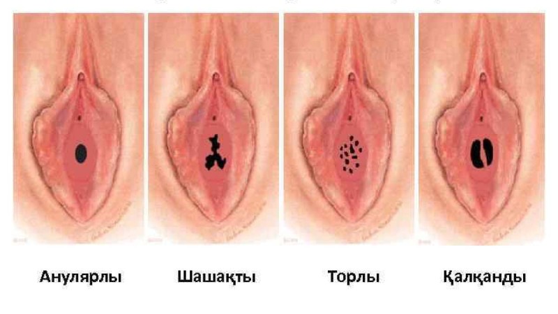 Әйел жыныс мүшелерінің ақаулары - презентация