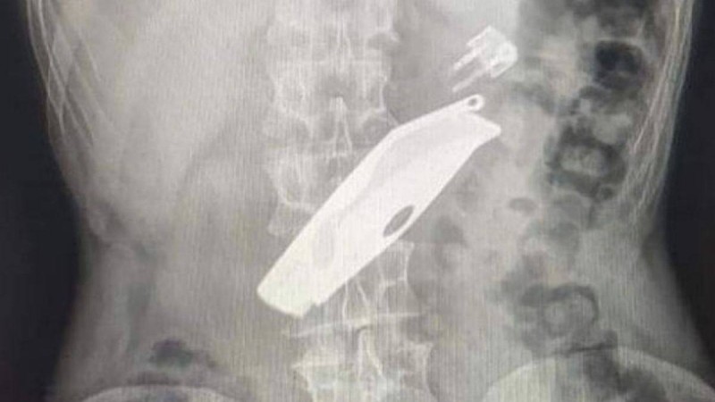 "Отбасылық күйзеліске түскендіктен істедім": СҚО-да ер азамат бәкі мен шақпақ жұтып, өліп кете жаздады - Қазақстан жаңалықтары