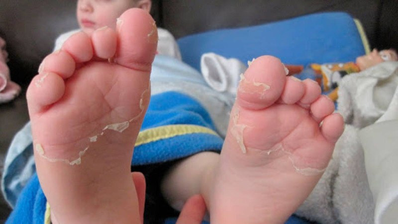 Қазақстанда Кавасаки синдромы бар екі бала көз жұмды