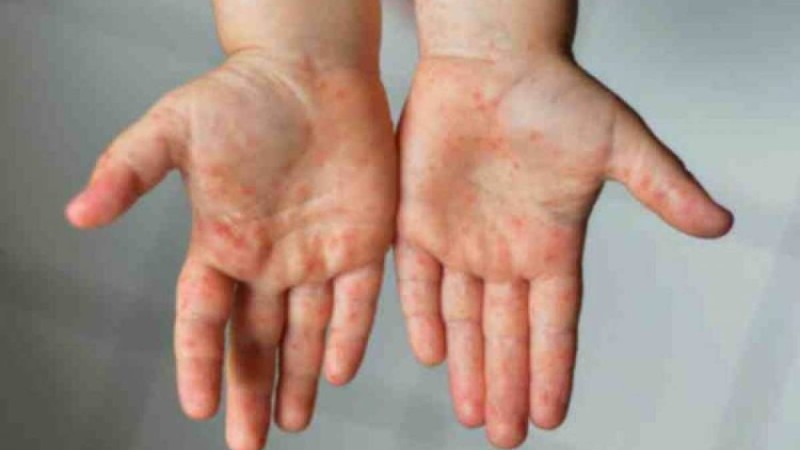 Министрлік Кавасаки синдромына шалдыққан балалар туралы айтты