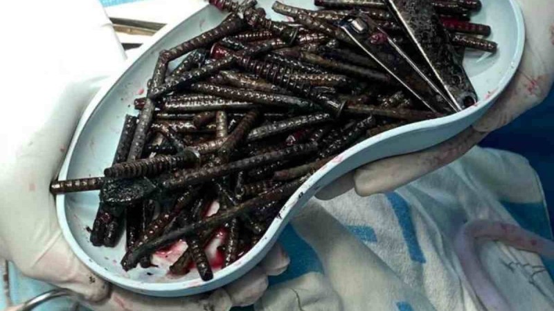 Ақмола облысында науқастың ішінен 100-ден астам бұранда табылды - Қазақстан жаңалықтары