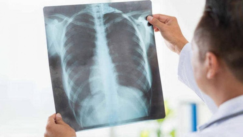 Нұр-Сұлтанда пневмониямен ауыратын 25 жастағы қыз қайтыс болды