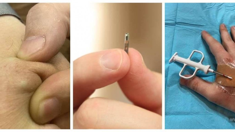 Чип салдырған бірінші қырғызстандық атанған жігіт тәжірибесімен бөлісті