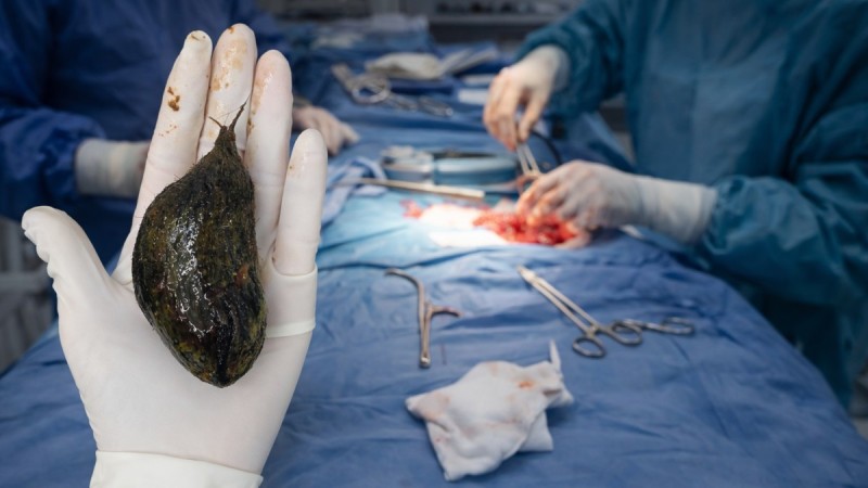 Түркістанда дәрігерлер жасөспірім қыздың асқазанынан 1 келіге жуық шаш түйінін алды