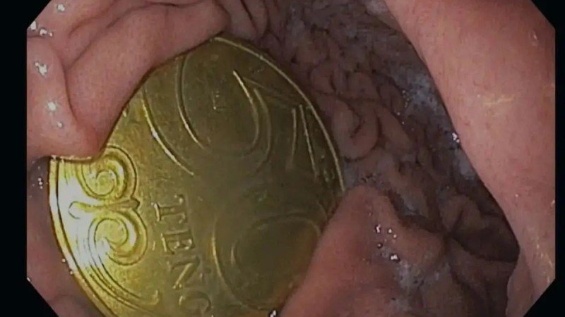 «Ата-анасы өзі түсіп қалады деп ойлаған»: Ақтауда бес жасар бала 50 теңгелік тиынды жұтып алып, үш күн жүрген (ФОТО)